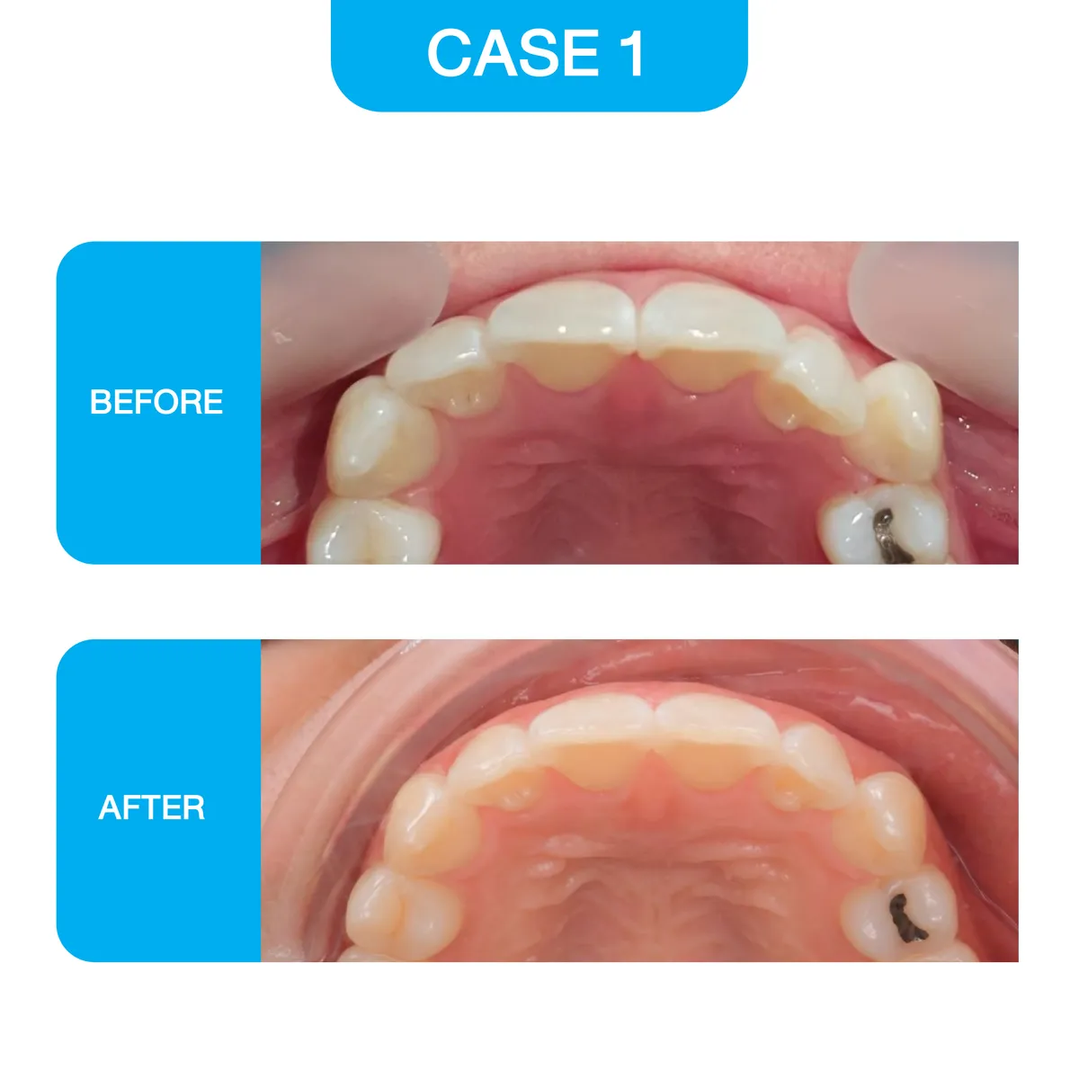 crystal-smile-2025-before-02
