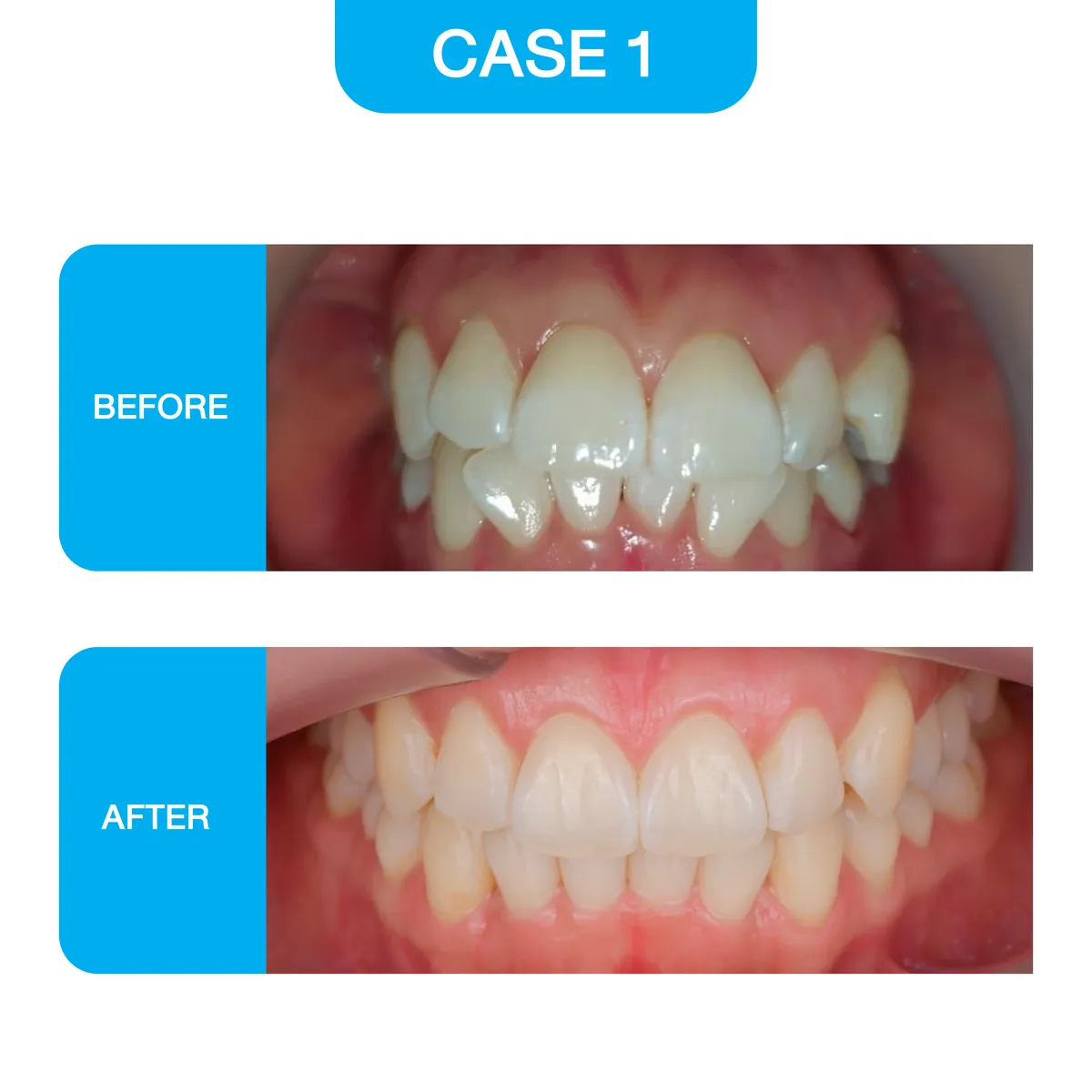 crystal-smile-2025-before-03