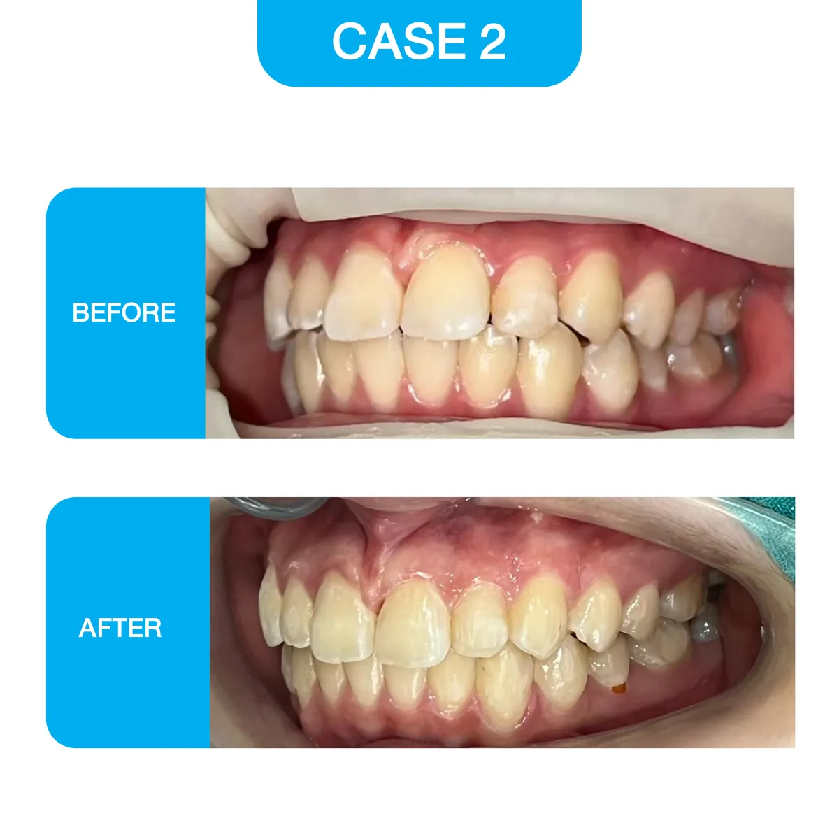 crystal-smile-2025-before-05