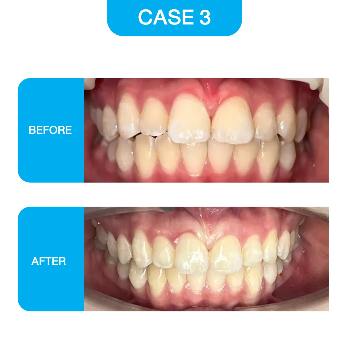 crystal-smile-2025-before-07
