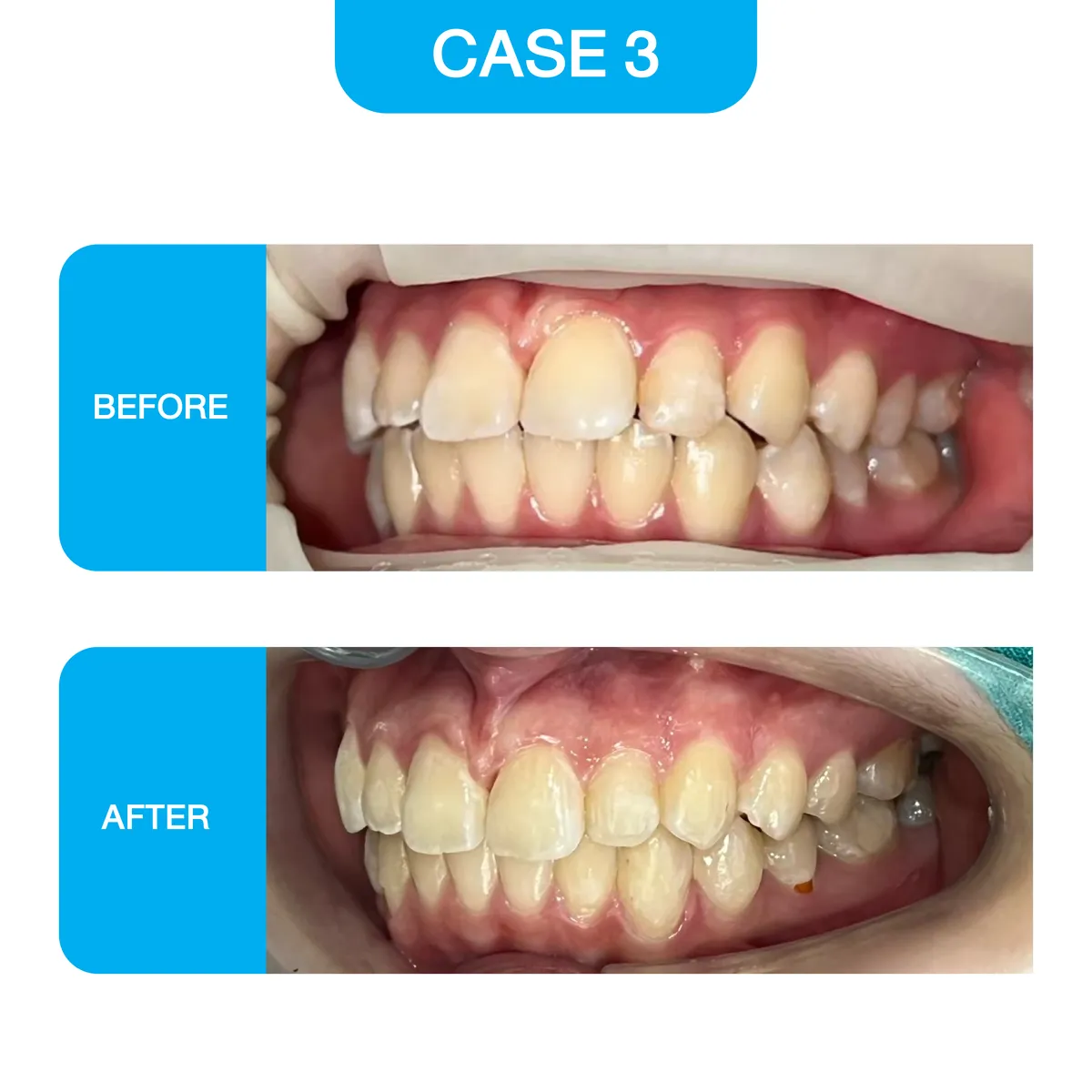 crystal-smile-2025-before-08