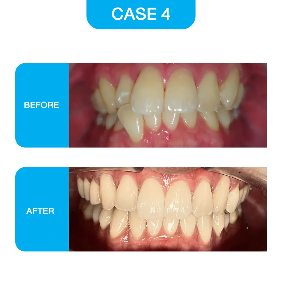 crystal-smile-2025-before-10
