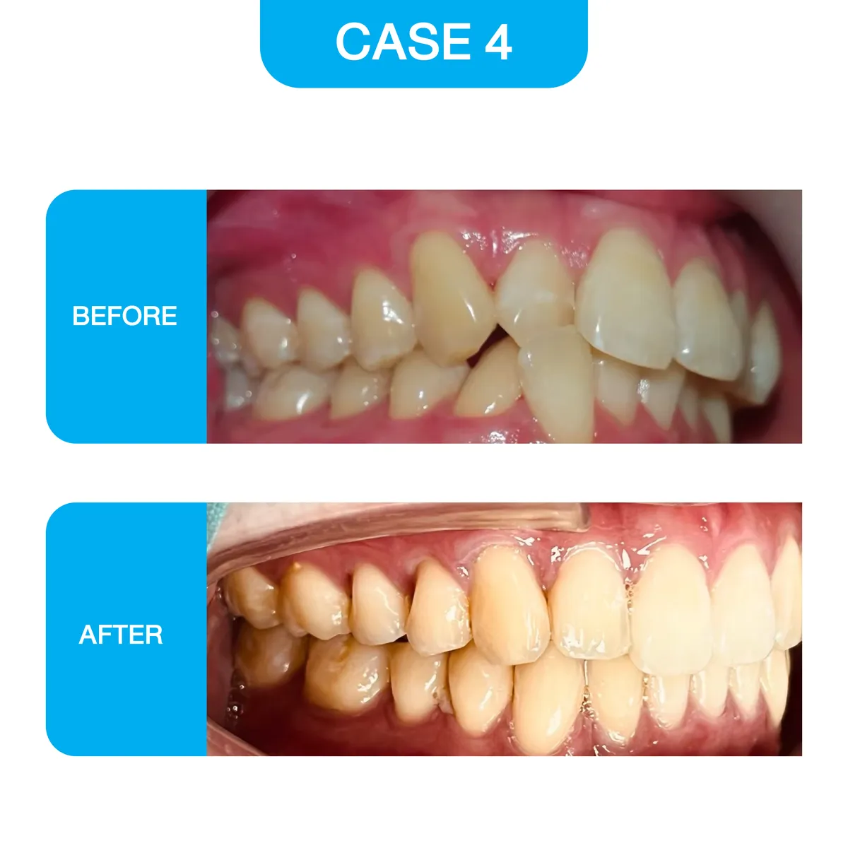 crystal-smile-2025-before-12